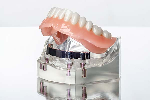 Denture stabilization with dental implants