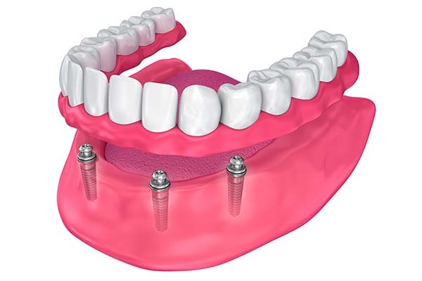 Dental implant supported denture