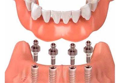 Removable implant-supported dentures